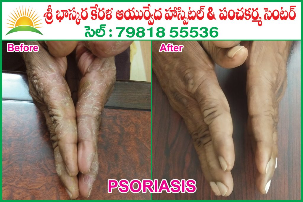 Psoriasis - Sri Bhaskara Kerala Ayurvedic Hospitals